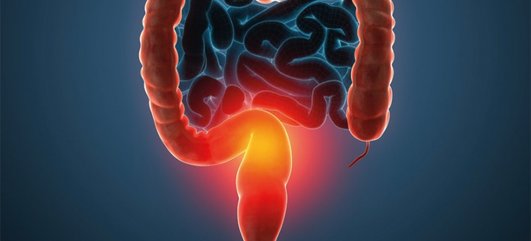 Doença de Crohn e Retocolite Ulcerativa