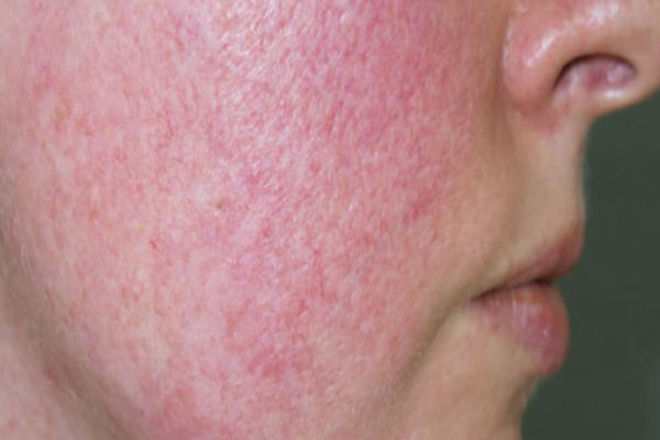 Rosácea - Vermelhidão facial que afeta a pele e a Autoestima
