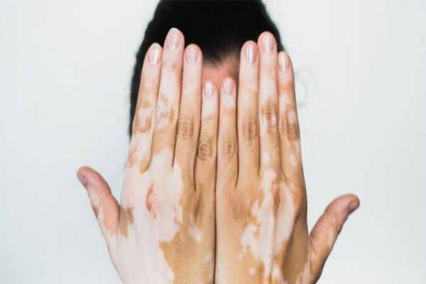Vitiligo: Esclarecendo as dúvidas e conhecendo as diversas opções terapêutica