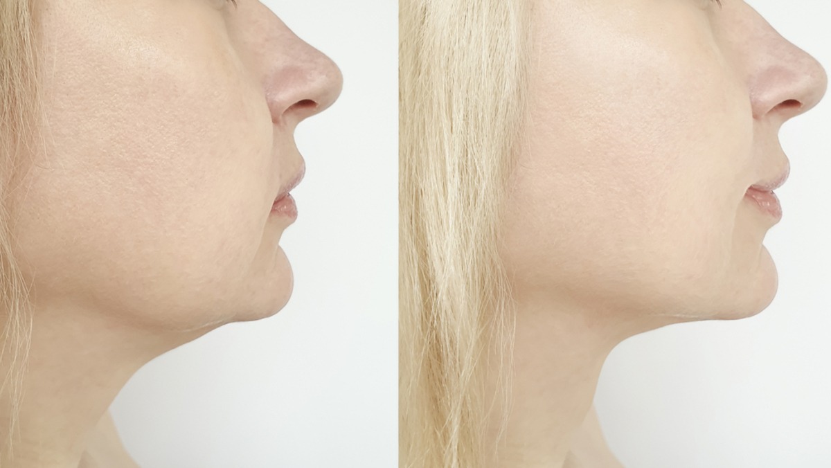 Cirurgia ortognática e a estética facial Cirurgia ortognática e a estética facial
