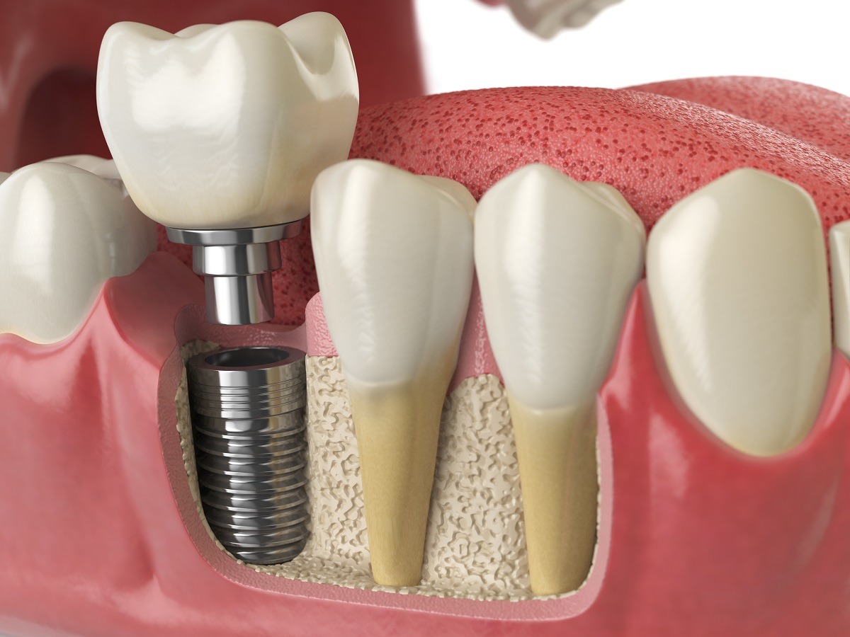 Implantes Dentários Implantes Dentários