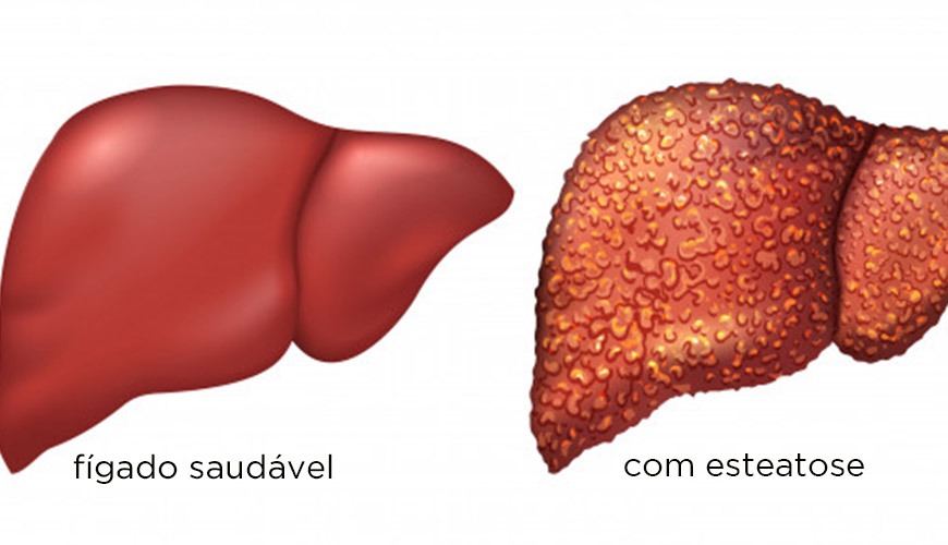 Esteatose Hepática A Doença Gordurosa do Fígado Esteatose Hepática A Doença Gordurosa do Fígado