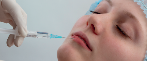 Preenchimento Labial e Nasolabial em Mulheres Preenchimento Labial e Nasolabial em Mulheres