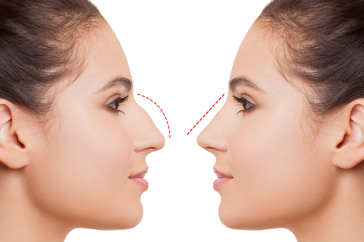 Rinoplastia - Um detalhe que pode fazer toda diferença na sua vida Rinoplastia - Um detalhe que pode fazer toda diferença na sua vida