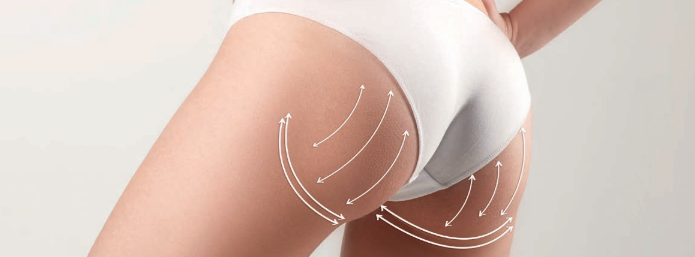 Glúteos: os injetáveis a favor do contorno perfeito