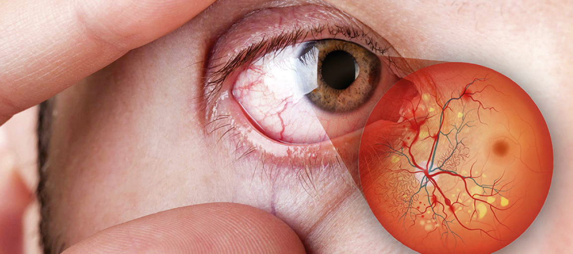 Impacto da Retinopatia Diabética na Visão: Abordagens Atuais para Prevenção e Tratamento