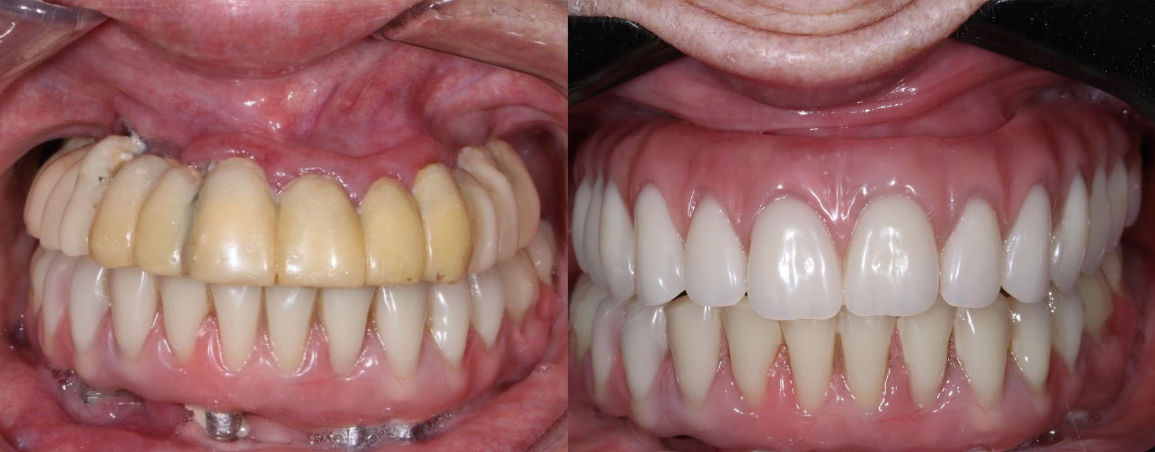 Estética em Implantodontia: Criando Sorrisos Naturais e Funcionais