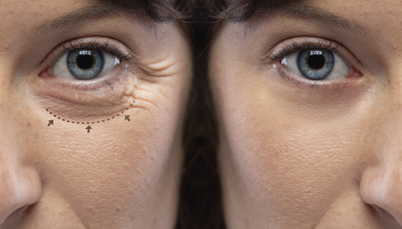 Blefaroplastia e Plástica Ocular: quando estética e saúde se encontram