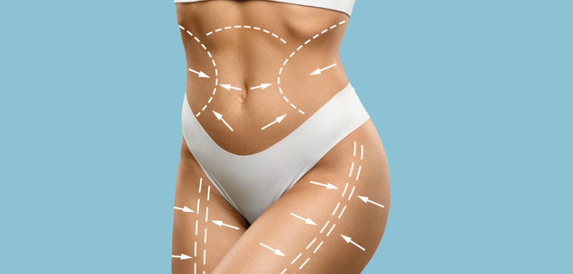 Argon 4: A Nova Geração da Lipoaspiração com Mais Firmeza e Menos Flacidez