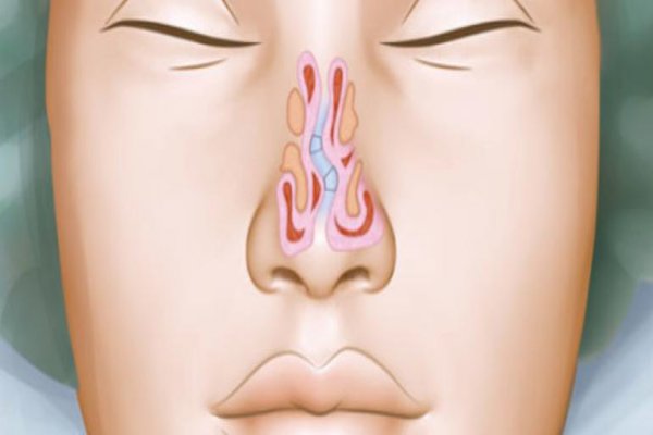 Desvio de Septo e Cirurgia de Amígdalas Desvio de Septo e Cirurgia de Amígdalas