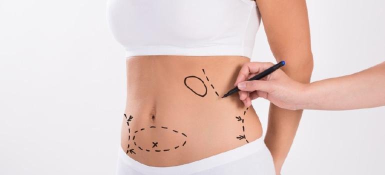 Lipoaspiração tem riscos? Como preveni-los? Lipoaspiração tem riscos? Como preveni-los?