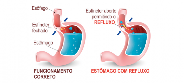 Cirurgia para tratamento de Refluxo Gastroesofágico Cirurgia para tratamento de Refluxo Gastroesofágico
