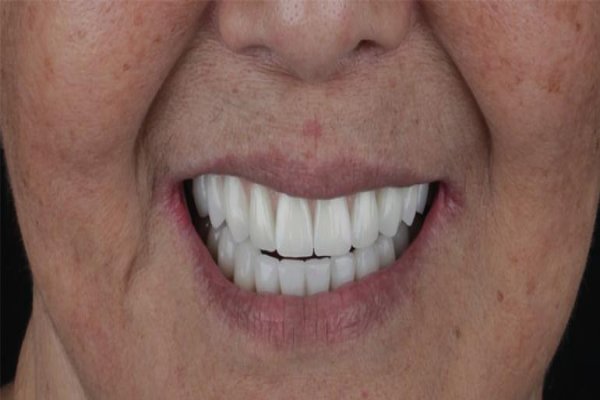 Implantes Dentários sem Cortes e sem Dor