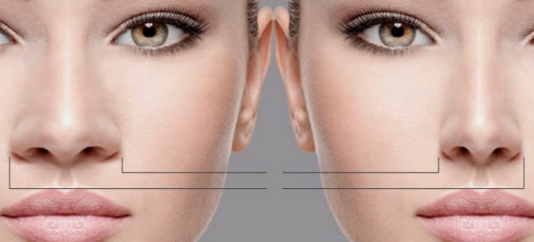 Rinoplastia - O que é, tipos de Cirurgia e como é feita! Rinoplastia - O que é, tipos de Cirurgia e como é feita!