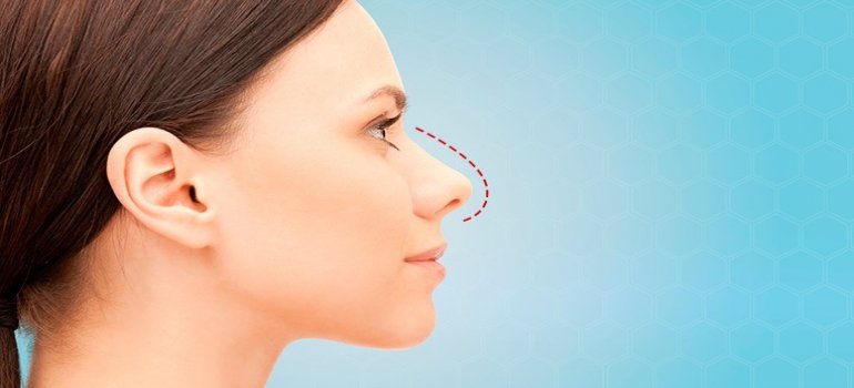 Rinoplastia Rinoplastia