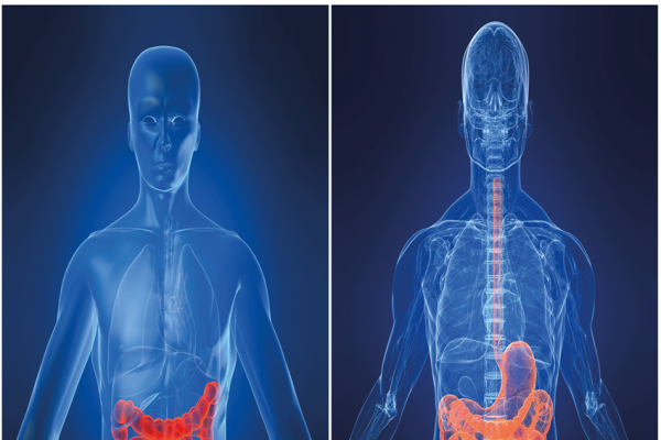 Câncer de Intestino Grosso: Como Prevenir? Câncer de Intestino Grosso: Como Prevenir?
