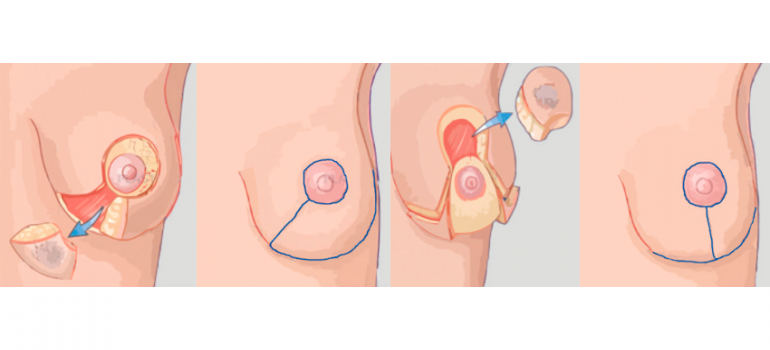Oncoplastia Oncoplastia